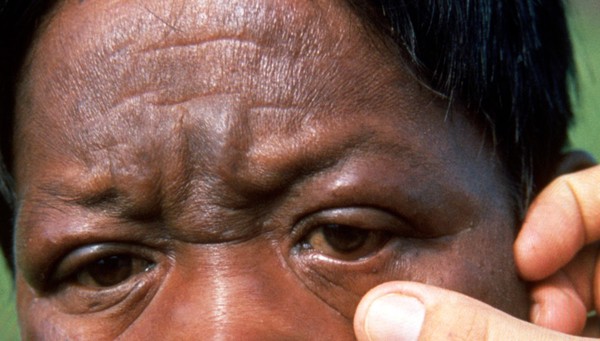 Leprosy: lepromatous leprosy