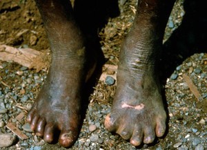view Leprosy: complications