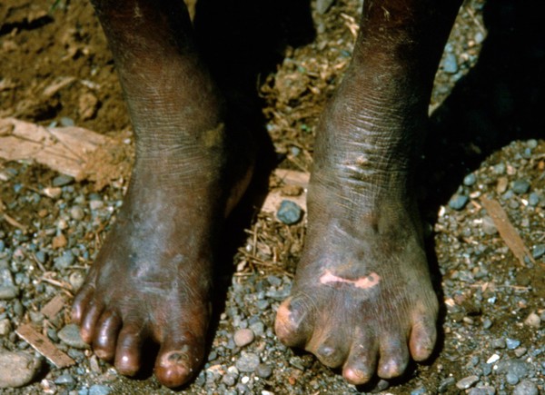 Leprosy: complications