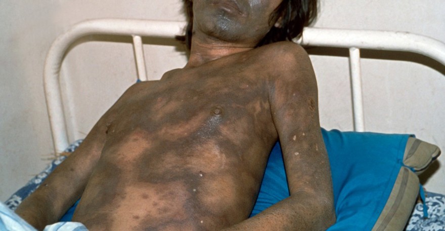 Leprosy: side effects of chemotherapy