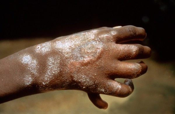 Mid-borderline leprosy: type 1 leprosy reaction