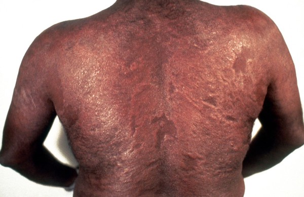 Borderline lepromatous (BL) leprosy