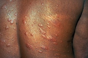 view Borderline lepromatous (BL) leprosy