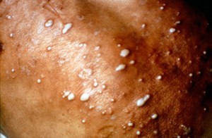 view Lepromatous leprosy : type 2 (erythema nodosum leprosum)