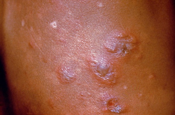 Lepromatous leprosy: type 2 (erythema nodosum leprosum)