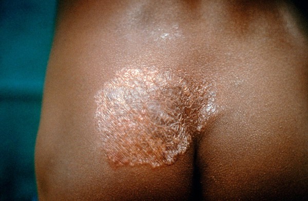 TB of the skin: lupus vulgaris 