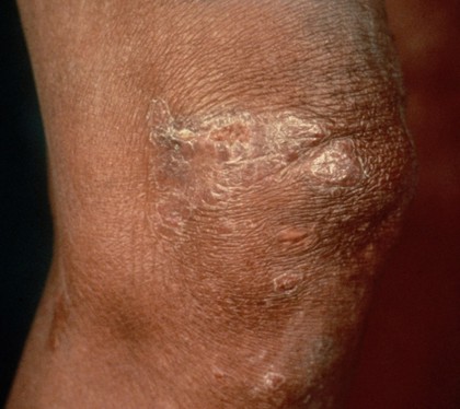 TB of the skin: lupus vulgaris