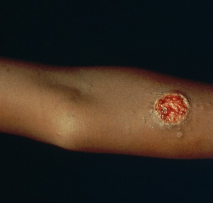 Ulcerated following tuberculin skin test