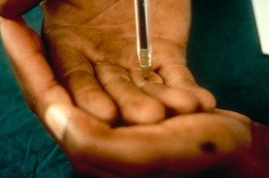 view Leprosy: diagnosis and investigation, sensory testing