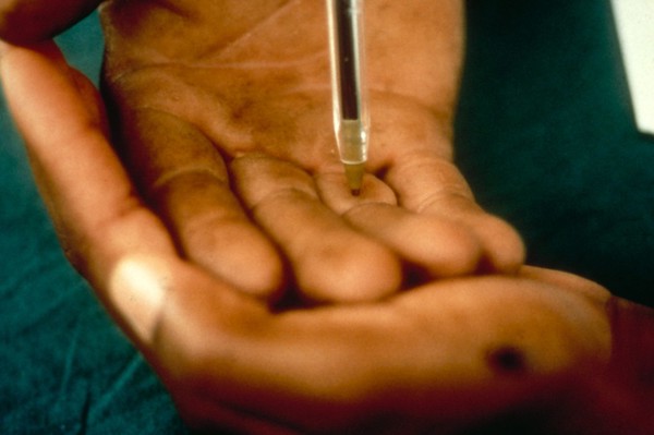 Leprosy: diagnosis and investigation, sensory testing