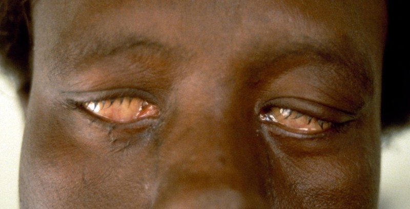 ocular-leprosy-complications-wellcome-collection