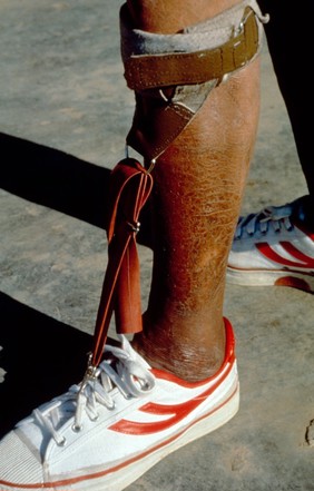Leprosy: physical aids/appliances