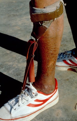 view Leprosy: physical aids/appliances