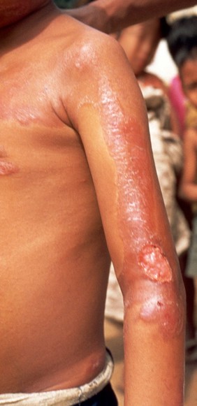 Leprosy: treatment, traditional medicine