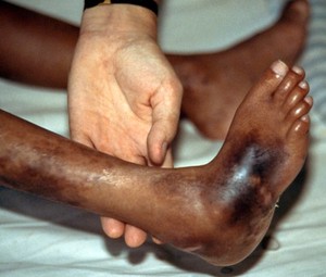 view Leprosy: complications