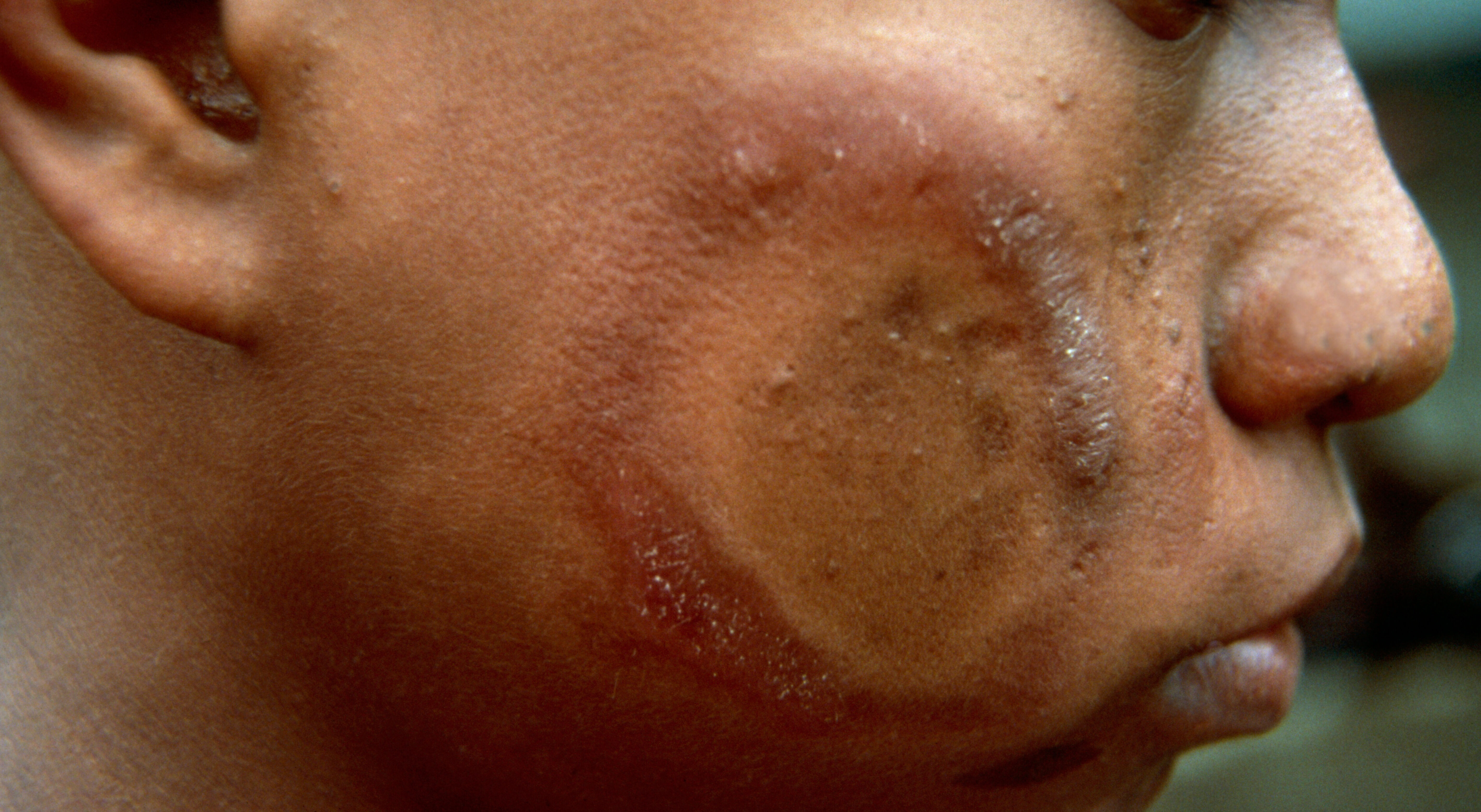 Borderline Tuberculoid Leprosy Type 1 Leprosy Reaction Wellcome Collection