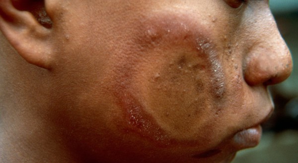 Borderline tuberculoid leprosy: type 1 leprosy reaction