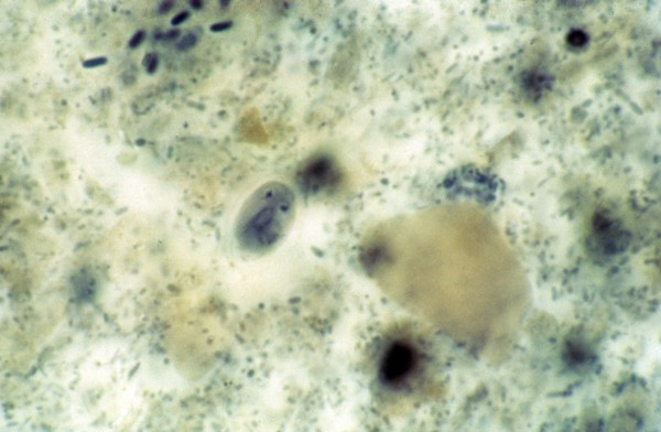 Giardiasis: <i>Giardia lamblia</i> cyst