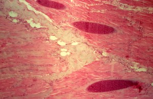 view Sarcocystosis: Sarcocysts in skeletal muscle