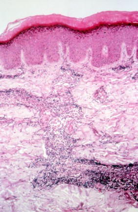 Old World cutaneous leishmaniasis: skin lesion 