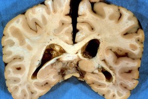 view Brain: tuberculous meningitis with HIV