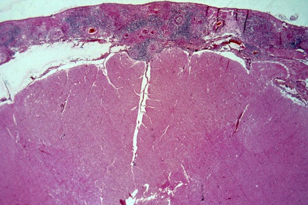 Tuberculous meningitis