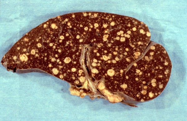 Spleen: miliary tuberculosis