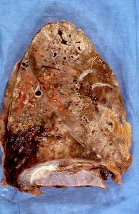 Tuberculous bronchopneumonia