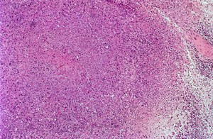 view Liver: miliary tuberculosis