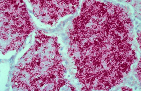 Lung: pulmonary tuberculosis