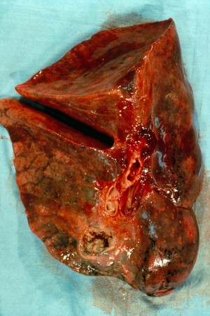 view Lung: pulmonary tuberculosis