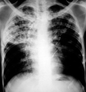view Nocardia pneumonia