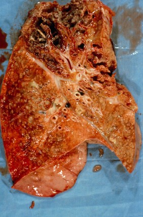 Lung: nocardiosis