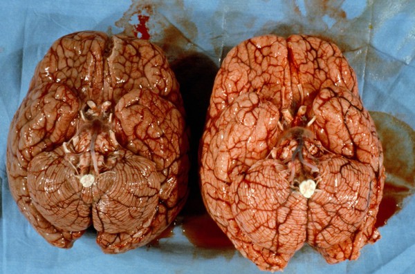 <I>Plasmodium falciparum</I> malaria affecting brain