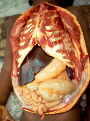 view <I>Plasmodium falciparum </I>malaria: liver and spleen