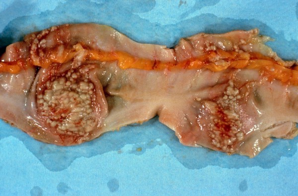 Small intestine: tuberculous ileitis