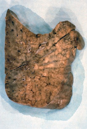 Lung: pneumocystis carinii pneumonia