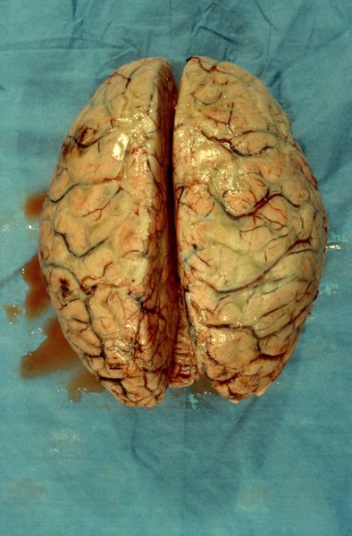 Brain: bacterial meningitis