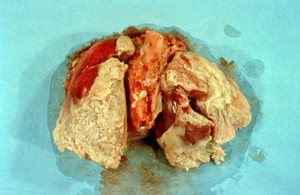 view Lung: septic pleurisy