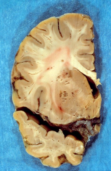 Brain: cryptococcal meningoencephalitis