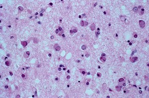 view Brain: measles encephalitis and HIV