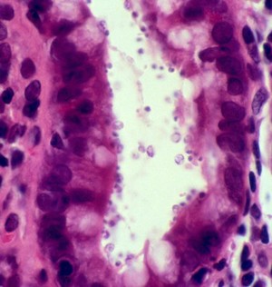 view Small intestine: <i>Cryptosporidium parvum </i> with HIV