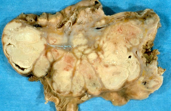 Lymph node: tuberculous lymphadenitis and HIV