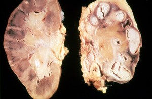 view Kidney: tuberculous pyonephrosis