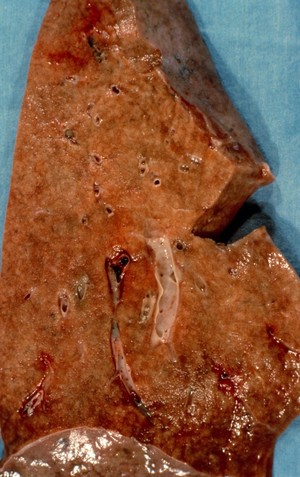 view Lung: pneumocystis carinii pneumonia and HIV
