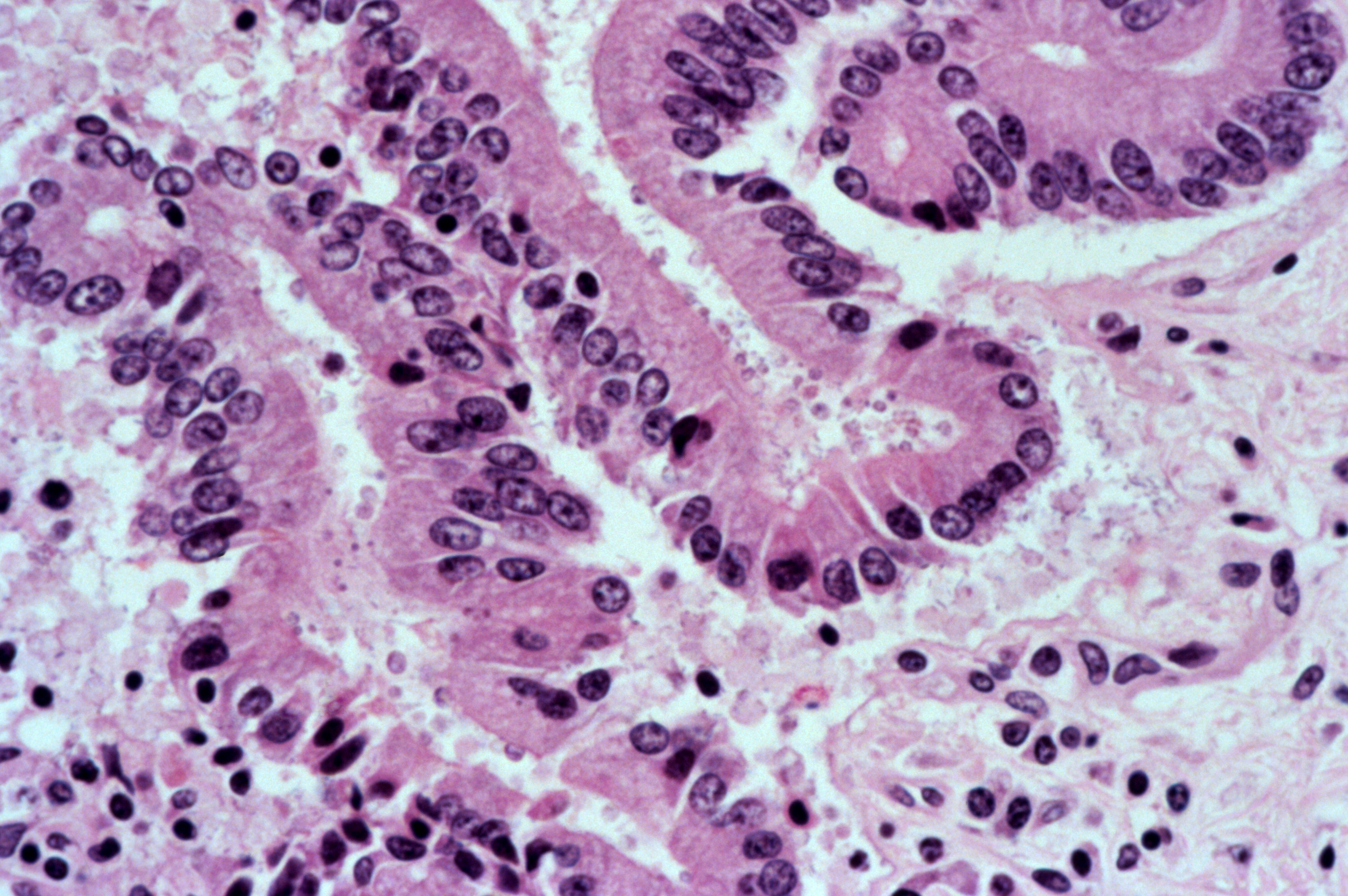 Cryptosporidium parvum in liver with HIV | Wellcome Collection