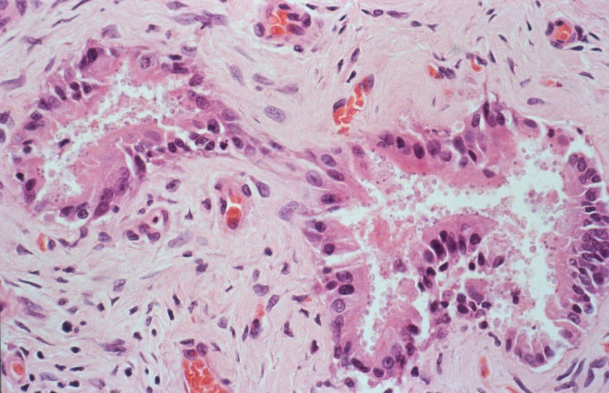 Cryptosporidium parvum in the liver and HIV