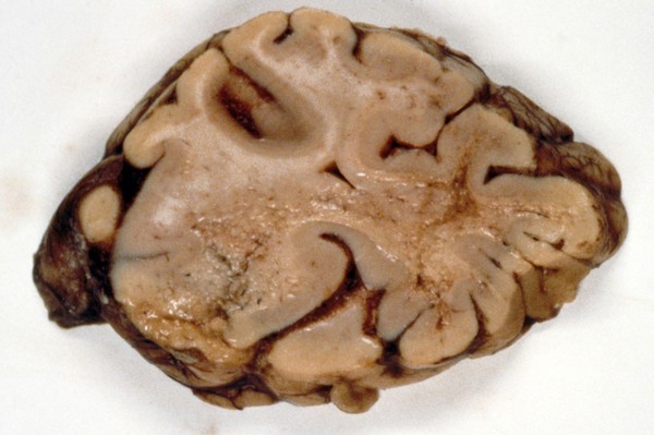 Brain: progressive multifocal leukoencephalopathy and HIV