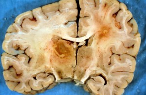 view Brain: cerebral toxoplasmosis and HIV