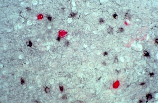 Brain: progressive multifocal leukoencephalopathy